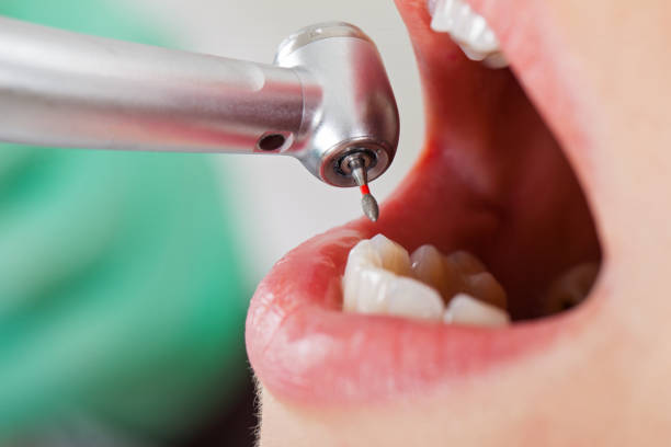 Best Emergency Treatment for Dental Infections or Abscesses in Menard, TX